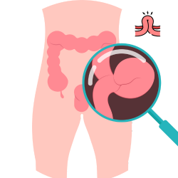 Hernias ventrales, umbilicales e inguinales