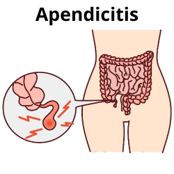 Apendicitis aguda